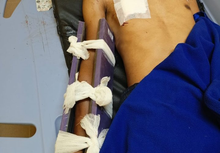 Warga Tanjung Sebauk Diterkam Buaya Saat Cari Gonggong, Alami Luka Serius dan Patah Tulang